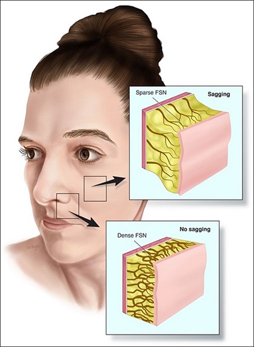 Topographical map of fibroseptal network density. The fibroseptal network (FSN) density varies at different anatomical areas of the face. Malar fat has a thicker subcutaneous layer with longer and less dense FSN arrangement. The FSN anatomy in this anatomical area results in skin sagging over time and deepening of the nasolabial sulcus. The thinner fat layer and dense FSN arrangement of the upper lip contributes to relatively fixed skin which is much less prone to sagging.