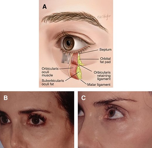 (A) Periorbital anatomy. The infraorbital region has a thin epidermal/dermal layer, scant subcutaneous fat, and a thin orbicularis oculi muscle layer. Safe treatment of this area requires an understanding of the tissue thickness and adjusting the depth of treatment accordingly. (B, C) A 60-year-old female with a total of 4 Morpheus8 periorbital treatments and no concomitant surgical treatment. She was treated according to the protocol in Table 1. The energy was 15J to 20J, with 2 to 3 passes. She had 3 treatments, 4 weeks apart. The first picture (B) was pretreatment. The follow-up picture (C) was at 16 months posttreatment.