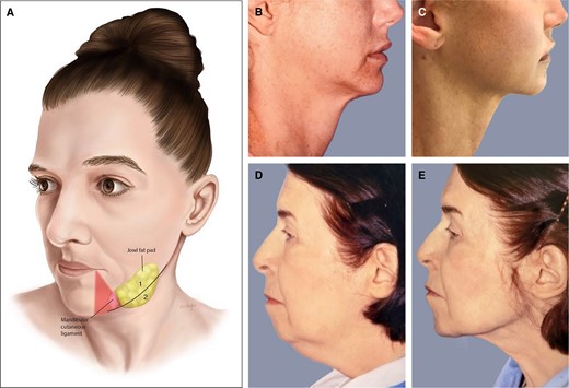(A) Jowls/mandibular border/neck anatomy. With aging, the jowl fat compartments descend posterior to the mandibular ligament, obstructing a smooth mandibular border. A line marks the mandibular border and the area above and below marked as 1 and 2. A triangle “no go zone” is marked before treatment, representing the relative location of the marginal mandibular nerve. (B, C) A 38-year-old female who had anterior platysmaplasty (submental incision) and 2 sessions of Morpheus8 of the neck, before (B) and after (C). (D, E) This is a 79-year-old patient who had both Morpheus and AccuTite treatment of her neck; (D) pretreatment and (E) posttreatment. Surgically she had a small chin implant. A small submental incision was made and the AccuTite probe was applied to treat the platysma. There was no concomitant surgical platysmaplasty. Muscle became thinner and flatter, and the contour was much improved.