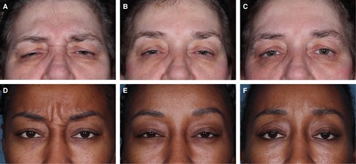 Treatment results in 2 patients injected with relaBoNT-A 50 U in the GLs. Photographs were taken before treatment on Day 0 (A, D), at 1 month (B, E), and 6 months (C, F) after treatment. GAIS was assessed by the patients themselves at maximum frown. (A-C) A 57-year-old woman with severe GLs at maximum frown at baseline (GL-ILA). GAIS results much improved at Months 1 and 6. Very satisfied with treatment at Months 1 and 6. (D-F) A 35-year-old woman with severe GLs at maximum frown at baseline (GL-ILA), GAIS results at Month 1: very much improved; Month 6: much improved; satisfied with treatment at Months 1 and 6.