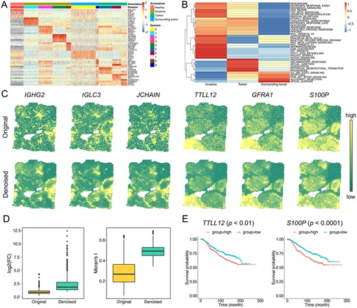 SpaSRL provides more biological insights into intratumour heterogeneity in BC sample. (A) The heatmap of original expression profiles of top five functional genes for each spatial domain identified by SpaSRL in Figure 2C. Each row of the heatmap indicates a gene and each column indicates a spot. The spots are labelled by histopathological annotations and SpaSRL assignments using column side colours. (B) The cancer hallmark enrichment of 357 functional genes in the Invasive, Tumour and Surrounding tumour regions. (C) Spatial expression of selected domain marker genes before (above) and after (below) data denoising. (D) The change of gene differential expression and spatial autocorrelation patterns before and after data denoising. FC: fold change of gene expression. (E) Survival analysis of the originally identified marker gene (i.e. TTLL2) and the newly identified marker gene (i.e. S100P).