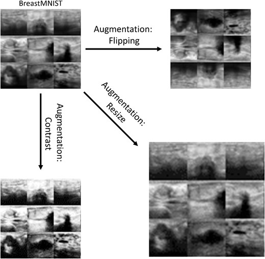 Examples of data augmentation using the BreastMNIST dataset. The types of augmentation shown are horizontal and vertical flipping (top right), scaling (bottom right) and contrast adjustment (bottom left).