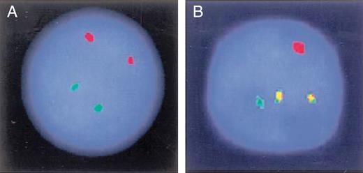 Interphase FISH using dual fusion probes on two separate nuclei to ...