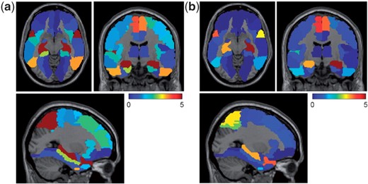 VBM weights of joint regression of AVLT scores and classification of disease status were mapped onto brain (a) Overall weights for disease classification; (b) Overall weights for AVLT regression