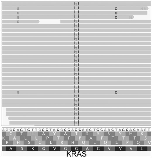 This Integrative Genomics Viewer (Thorvaldsdóttir et al., 2013) window covers a portion of the human KRAS gene. The C > T variant is the classic KRAS G12D mutation that appears in many PDAC tumors. The A > G and T > C variants both result from aligning wild-type mouse reads to the human sequence. When used with MuTect 1.1.1 or Varscan 2, MAPEX correctly retains only the G12D variant. MuTect2, however, filters all three variants, so the G12D variant cannot be retained