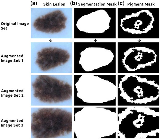 Augmenting an image with multiple masks. The top row contains, from left to right, (a) the original lesion scan, (b) the segmentation mask and (c) the pigment mask. Images can be grouped along with their masks and fed simultaneously into the pipeline, creating randomly augmented images yet ensuring the transformations are applied identically to all images within each set (Augmented sets 1, 2 and 3 above). Images from ISIC challenge dataset (Codella et al., 2017; Tschandl et al., 2018)