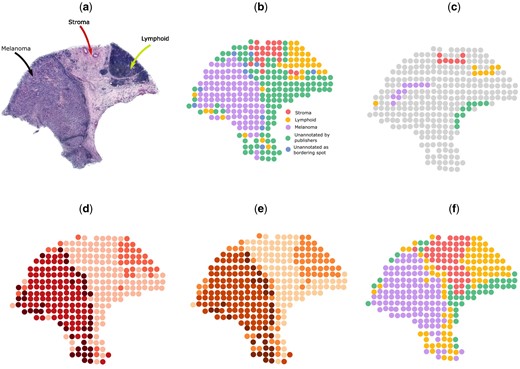 Analysis on melanoma ST sample. (a) Histology image. (b) Manual annotation. (c) Scribbles by a human annotator. (d) Spatial domains detected by BayesSpace. (e) Spatial domains detected by AutoScribbleDom. (f) Spatial domains detected by ScribbleDom.