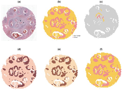 Analysis on human breast cancer dataset. (a) Histology image. (b) Manual annotation. (c) Scribbles by a human annotator. (d) Spatial domains detected by BayesSpace. (e) Spatial domains detected by AutoScribbleDom. (f) Spatial domains detected by ScribbleDom.