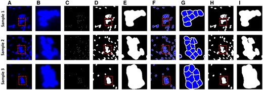 Nuclear segmentation results for counting the number of nuclei. (A) is the original nuclei image. (B) is an enlarged image of the box in (A). (C) and (D) are nuclei centroid images and nuclei semantic segmentation, which are the results of the deep learning model. (E) is an enlarged image of the box in (D). (F) is an image obtained by applying the marker-controlled watershed algorithm from (C) and (D). (G) is an enlarged image of the box in (F). (H) is a result trained to segment overlapped nuclei directly from deep learning without watershed. (I) is an enlarged image of the box in (H).