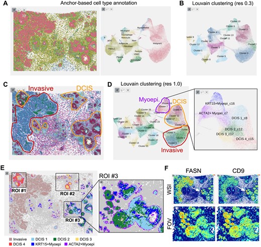 A case study for a breast cancer sample. (A) Spatial and scatterplot (UMAP) views of anchor-based cell type annotation results. (B) UMAP plot of Louvain clustering results at resolution 0.3. (C) Tissue image view with pathological assignment of disease state. Cells are colored according to the Louvain clustering results shown in (D). Area of interest is magnified for detailed assignment. (E) Regions of interest (ROIs). Cells are colored by the cell type subclusters shown in (D). (F) Tissue images colored by the expression of marker genes FASN and CD9. The upper and lower images are the whole slide image (WSI) and ROI #3, respectively.