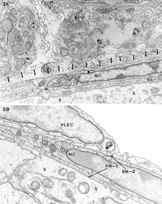 Electron microscopy of the testis of A) a masculinized Dhh-null mutant animal and B) a control heterozygous mouse. The Sertoli cell (S), myoid cell (MC), and intervening basal lamina (BL) are indicated. The major difference between the masculinized Dhh-null and heterozygous animals was the absence, in the former, of the parietal layer of the lymphatic endothelium, its normal position indicated by arrows in A. Typical Leydig cells (L) characteristic of adult-type are shown outside the seminiferous tubule of the masculinized animals. The main feature characterizing these cells was the relatively increased cytoplasmic density of the cells compared with fetal-type Leydig cells, abundance of SER and mitochondria, and a relative scarcity of lipid and glycogen (arrowheads). In B, two seminiferous tubules are juxtaposed. Indicated are the Sertoli cells (S), intervening basement membrane (BM-1) between Sertoli cells and myoid cells (MC), the basement membrane external to the myoid cell (BM-2), and the parietal lymphatic endothelial cells (PLEC). Magnification of A = ×15 000; B = ×18 000