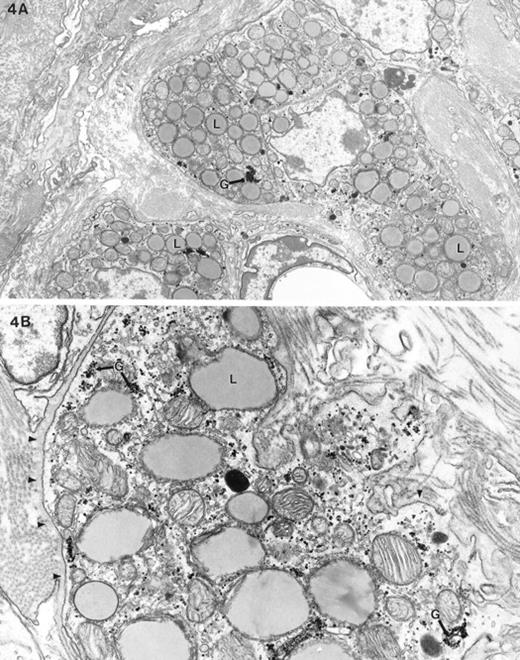 Electron micrograph of fetal-type Leydig cells in Dhh-null feminized mice. A) This low-power view of Leydig cells shows a cluster of fetal-type Leydig cells, abundant lipid (L), no swirled endoplasmic reticulum, and dense clumped glycogen (G). B) The higher magnification micrograph shows these aforementioned features as well as the abundant glycogen (G). Note the cytoplasmic density of fetal-type Leydig cells is low compared with the adult-type Leydig cells shown in Figure 3A. A basal lamina (arrowheads) surrounds the clump of Leydig cells. Magnification of A = ×6500; B = ×18 900