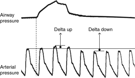Illustration of the Delta up and DD measurements. First line represents the upper airway pressure and the second line represents the invasive arterial pressure. Explanations can be found in the text.