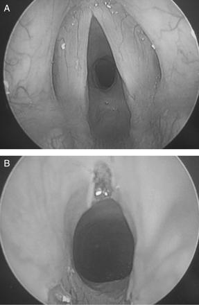 (a) Larynx pre-laser treatment; (b) larynx post-laser treatment.