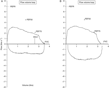 (a) Preoperative flow volume loop; (b) flow volume loop post-laser treatment. FVC, forced vital capacity; FEV1, forced expiratory volume in 1 s; PEFR, peak expiratory flow rate; FEF75, forced expiratory flow at 75% FVC; FEF50, forced expiratory flow at 50% FVC; FEF50 and 75% maximal expiratory flow measured at the point where 50% of the FVC has expired and after 75% has expired. X-axis, volume in litres; Y-axis, flow in litre s−1.