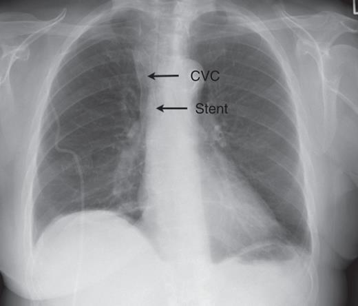 In this patient, a CVC has been sited successfully through a stent ...