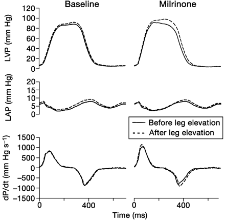 Fig 1 Representative example of the effects of leg elevation in baseline conditions and after milrinone. In the presence of milrinone, the effect of leg elevation on LV haemodynamics is more pronounced.