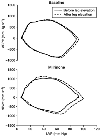 Fig 2 dP/dt vs pressure phase–plane plots illustrating the effects of leg elevation on rate and pattern of pressure decline. In each panel, a beat after leg elevation is compared with the baseline beat. With milrinone, the effect of leg elevation was more pronounced.