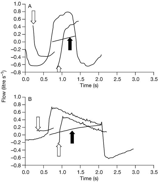 patient ventilator interaction bja british journal of anaesthesia