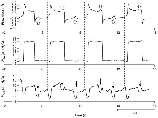 patient ventilator interaction bja british journal of anaesthesia
