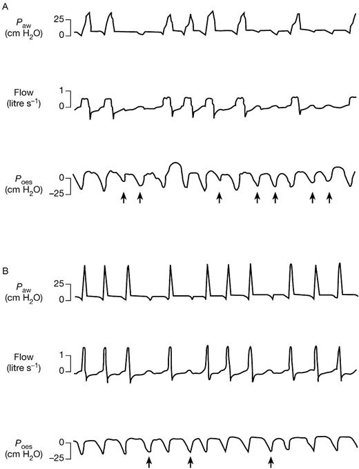 patient ventilator interaction bja british journal of anaesthesia
