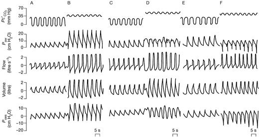 patient ventilator interaction bja british journal of anaesthesia