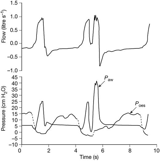 patient ventilator interaction bja british journal of anaesthesia
