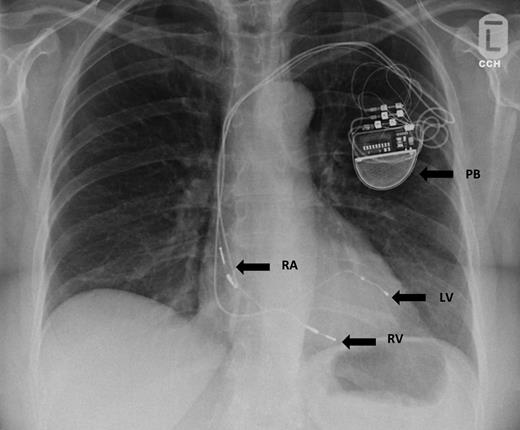 Biventricular Pacemaker