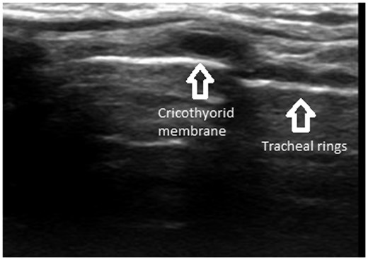 Parasagittal ultrasound of the neck showing tracheal rings (string of pearls) and the cricothyroid membrane.