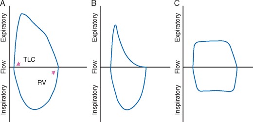Flow volume loops: (A) normal inspiratory and expiratory limb, (B) the slowing and flattening of the expiratory limb in COPD, and (C) fixed upper airway obstruction showing plateaus in both the inspiratory and the expiratory limbs.