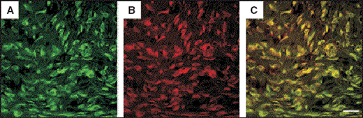 Immunohistochemical staining for α‐smooth muscle actin in granulation tissue formed by green fluorescent protein (GFP)‐labelled bone marrow cells. Specimens were analysed with anti‐α‐smooth muscle actin antibody conjugated with CyTM3 (indocarbocyanine) as a specific marker for wound myofibroblasts. Immunofluorescence images showed that the green fluorescence was derived from spindle‐shaped GFP‐positive bone marrow cells (A) and the red fluorescence from CyTM3‐conjugated α‐smooth muscle actin (B) under excitation at 489 nm and 550 nm, respectively. Double‐labelling fluorescence revealed that most spindle‐shaped GFP‐positive cells also expressed the wound myofibroblast marker (C). This differentiation did not occur in muscle, adipose or dermal tissue (of GFP‐transgenic rat origin) transplanted onto normal rat wounds. Some GFP‐positive peripheral blood cell transplants very slightly differentiated into myofibroblasts, but the number of cells was much lower than with bone marrow cells. Scale bar = 20 µm (A–C).