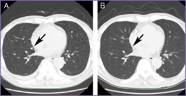 (A) Chest computed tomographic scan showing a small nodule in the right lung (arrow). (B) After one course of weekly low‐dose docetaxel treatment, the nodular lesion had completely disappeared.