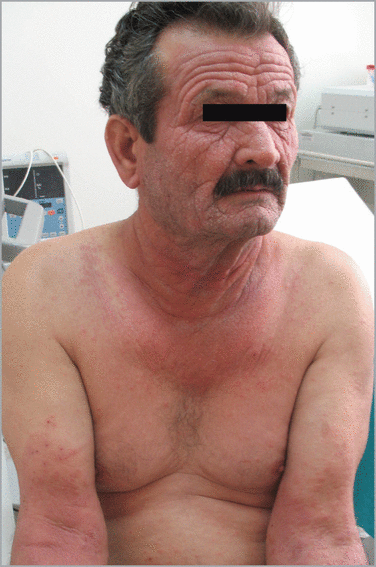 Photodermatoses with onset in the elderly | British Journal of ...