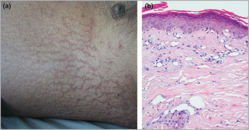 Patient 3. (a) Extensive eruption of the abdomen, with typical appearance of asteatotic eczema. (b) Histology of a skin biopsy shows epidermis covered by dotted parakeratosis with interface dermatitis, vacuolar basal keratinocytes, and a sparse inflammatory infiltrate of the upper dermis (haematoxylin and eosin).