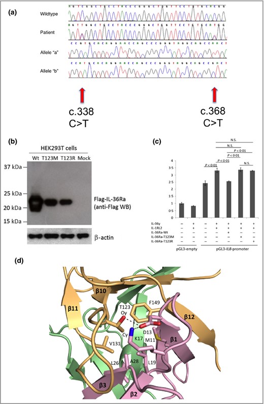 Mutation analysis of IL36RN in both patients, and functional and molecular evidence supporting the pathogenicity of the Thr123 (T123R) change. (a) Sanger sequencing analysis revealed compound heterozygous mutations in the proband's DNA. Mutations are shown at two positions within IL36RN exon5 (‘Patient’), c.338C>T and c.368C>T, which differs from the wild‐type sequence (‘Wild type’). Single allele analysis, carried out by cloning the polymerase chain reaction products followed by sequencing, reveals the presence of the c.338 C>T mutation (‘Allele ‘a’) and the c.368C>T on the other chromosome (‘Allele ‘b’). (b) Expression of the p.Thr123Met mutant interleukin 36 receptor antagonist (IL‐36Ra) protein is severely impaired compared with that of the wild type (Wt) IL‐36Ra in HEK293T cells. All constructs were verified by direct sequencing. β‐Actin was blotted as a normalization control. (c) IL8 promoter–reporter gene assays demonstrate loss of function of the p.Thr123Met mutant IL‐36Ra protein in HeLa cells. The IL8 promoter activity induced by interleukin (IL)‐36γ and IL‐1RL2 was significantly downregulated by the Wt IL‐36Ra (P < 0·01, Student's t‐test) but not by the p.Thr123Met or the p.Thr123Arg mutant IL‐36Ra. All experiments were performed in triplicate and repeated three times. The error bar indicates the SEM of a single representative experiment. NS, not significant. (d) Diagrams of the core hydrophobic patch in the human IL‐36Ra protein. The three‐dimensional structure of human IL‐36Ra was modelled (Swiss model; http://swissmodel.expasy.org/) using a reported murine IL‐1F5 structure (Protein Data Bank identifier: 1MD6) as a template.8 9 10 The predicted structure was generated using Pymol v0.99 (DeLano Scientific, San Carlos, CA, U.S.A.). Three β‐hairpins of IL‐36Ra are shown by purple (residues 1–46), green (residues 47–104) and orange (residues 105–155) ribbon representations. Amino acid residues that contribute to the stability of the conformation of IL‐36Ra, which interact with Thr123, are highlighted by stick presentations in red and blue. Suggested hydrogen bonds between these residues are shown as dotted lines.