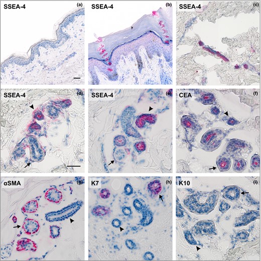 The expression pattern of stage‐specific embryonic antigen‐4 (SSEA‐4) and sweat gland markers in human skin. Analysis of SSEA‐4 antigen expression: (a) the interfollicular epidermis, breast; (b) the acrosyringium, palm; (c) the intradermal straight duct, breast; (d, e), proximal reabsorption and secretory portion of the eccrine sweat glands, breast and abdomen. Staining of sweat gland markers: (f) carcinoembryonic antigen (CEA) present in luminal membranes of both secretory and ductal cells, breast; (g) α smooth muscle actin (αSMA) expressed in myoepithelial cells, abdomen; (h) keratin 7 (K7) localized only in luminal cells in the secretory coil of sweat glands, palm; (i) keratin 10 (K10) absent from sweat glands, breast. Ducts indicated by arrowheads; secretory portion indicated by arrows; (a–c) × 200, (d–i) × 400. Scale bars 50 μm.