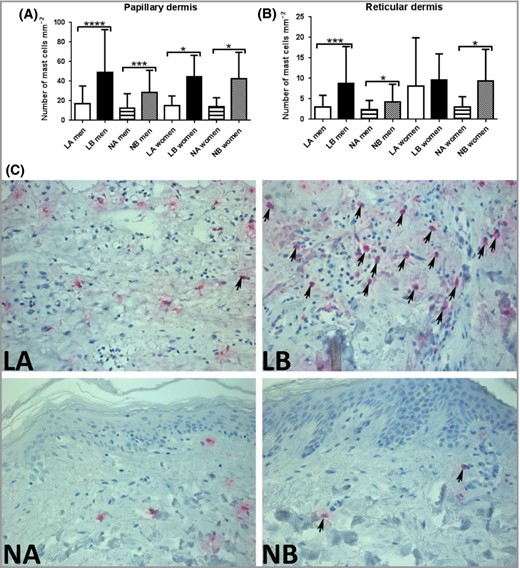 Effect of siramesine on mast‐cell density in biopsies from lesional and normal skin from patients with psoriasis. Skin biopsies (3‐mm) were incubated in medium with or without siramesine (20 μmol L−1) for 72 h (men, n = 18; women, n = 7). Sections from the biopsies were then evaluated for the presence of mast cells by tryptase immunostaining. The graphs show the number of mast cells (mean values ± SD) per mm−2 in papillary dermis (A) and reticular dermis (B). Wilcoxon matched‐pairs signed‐rank test *P < 0·05, ***P < 0·001, ****P < 0·0001. The number of mast cells was higher in lesional skin compared with nonlesional skin in men, both in papillary (P = 0·012) and reticular (P = 0·016) dermis. (C) Representative images showing the effect of siramesine on tryptase‐expressing cells (arrows) in skin biopsies from one patient. LA, treated lesional skin; LB, untreated lesional skin; NA, treated nonlesional skin; NB, untreated nonlesional skin.