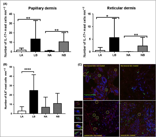 Effect of siramesine on IL‐17 and IL‐6‐positive mast cells in biopsies from patients with psoriasis. Skin biopsies (3‐mm) from 25 patients with psoriasis were incubated for 72 h in medium with or without siramesine (20 μmol L−1). Sections from the biopsies were then stained for the presence of IL‐17+ and IL‐6+ mast cells by double immunofluorescence. (A) The number of IL‐17+ mast cells (mean values ± SD) per mm−2 was calculated in the papillary and reticular dermis, respectively. (B) IL‐6+ mast cells (mean values ± SD) per mm−2 in skin sections. (C) Representative images showing the effect of siramesine on the presence of cells double positive for tryptase (red) and IL‐6 (green). IL‐6+ mast cells (IL‐6+tryptase+) are encircled. Nuclei are visualized by DAPI staining (blue). Representative IL‐6+tryptase+ cells are shown at the left side of the panel at larger magnification. Wilcoxon matched pairs signed rank test *P < 0·05, **P < 0·01. ***P < 0·0001. IL, interleukin; LA, treated lesional skin; LB, untreated lesional skin; NA, treated nonlesional skin; NB, untreated nonlesional skin.