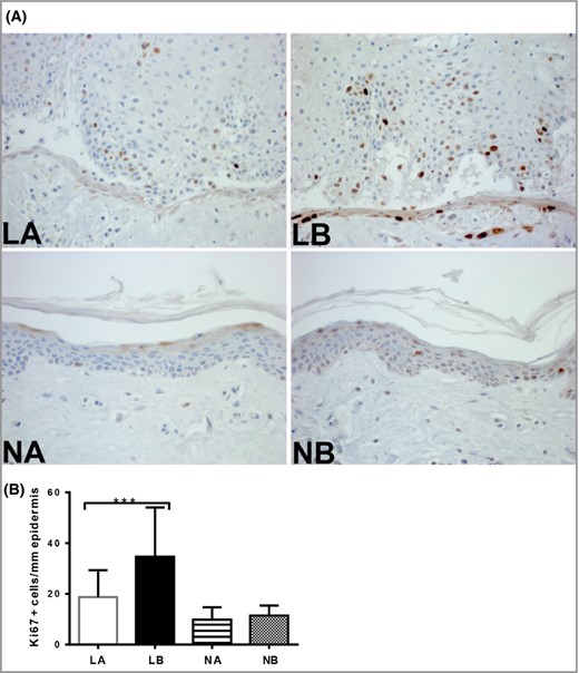 The effect of siramesine on the proliferative activity of epidermal cells in biopsies from patients with psoriasis. Skin biopsies (3‐mm) were incubated in medium with or without siramesine (20 μmol L−1) for 72 h. (A) Sections from the biopsies were then stained with the proliferation marker Ki‐67. (B) Quantification of Ki‐67‐positive cells per mm2 basement membrane. Graphs represent means ± SD (n = 25). Wilcoxon matched‐pairs signed‐rank test ***P < 0·0001. LA, treated lesional skin; LB, untreated lesional skin; NA, treated normal skin; NB, untreated normal skin.