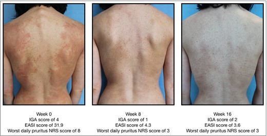 Example of improvement in Eczema Area and Severity Index (EASI) from baseline to week 16 in a patient receiving tralokinumab. IGA, Investigator’s Global Assessment; NRS, numerical rating scale.