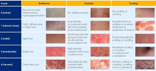 GPPGA severity criteria excerpts from the Generalized Pustular Psoriasis Severity Scoring (GPPASI and GPPGA) pocket guide (please also refer to ‘The GPPGA score’, available on Figshare, https://doi.org/10.6084/m9.figshare.22664869.v1).