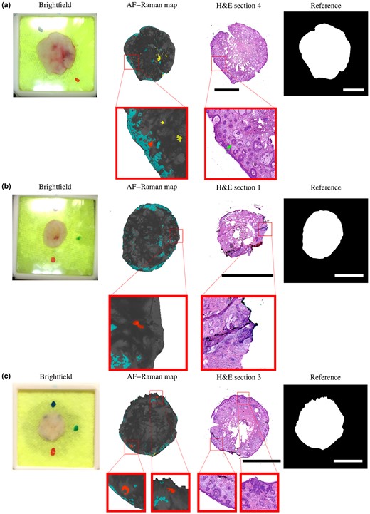 Examples of false-positive autofluorescence (AF)–Raman microspectroscopy assessments caused by (a) incipient hair follicles, (b) dense inflammation and (c) benign naevus and hair follicles. Brightfield images show the tissue layers placed in the AF–Raman cassette with coloured markers used to preserve orientation. Raman maps show red regions, even though there is no basal cell carcinoma present at the resection surface, as shown in the frozen haematoxylin and eosin (H&E)-stained sections and confirmed by the reference standard (no markings on the reference report). Scale bars = 5 mm.