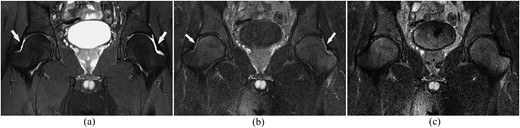 application of T2W SPIR-FLAIR in the diagnosis of hip synovitis in ...
