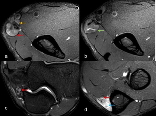 Axial T 2W SE FS images (a-d) depict marked thickening and altered signal intensity of ulnar nerve (red arrow) with large abscess (green arrow) formation. In addition, local nodes can be visualized (yellow arrow), with secondary denervation in flexor carpi ulnaris (blue arrow). FS, fat saturated; SE, spin echo.