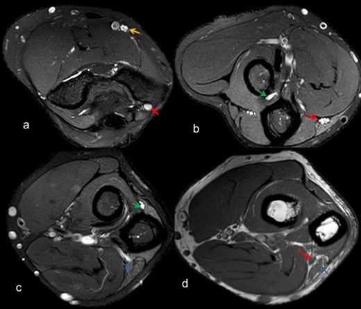 Axial T2 weighted SE FS images (a-c) depict thickening and altered signal intensity of ulnar nerve (red arrow), median nerve (yellow arrow), posterior interosseous nerve (green arrow) along with denervation changes in flexor carpi ulnaris (blue arrow), (d) T 1W SE depicts thickening of ulnar nerve (red arrow) with fatty infiltration in flexor carpi ulnaris (blue arrow). FS, fat saturated; SE, spin echo.