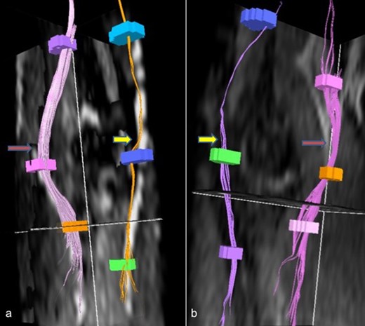 Reformatted DTI images (a, b) shows affected ulnar nerves (yellow arrow) with reduced density of fibers as compared to other normal nerves (red arrow). DTI, diffusion tensor imaging.