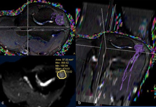 DTI –T2 weighted axial (a) and coronal reformatted (b) images depicting fibers of ulnar nerve at the cubital tunnel (c) Diffusion weighted axial image depicting mean cross-sectional area of 97 mm2 with mean FA of 0.407 and mean ADC of 1.145 × 10–3 mm2 /s. ADC, apparent diffusion coefficient; DTI, diffusion tensor imaging; FA, fractional anisotropy.