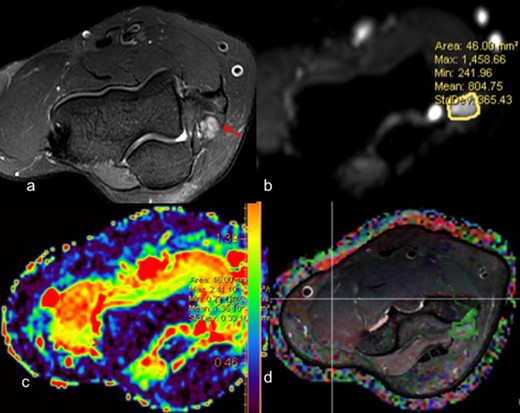 (a)T2 weighted axial fat suppressed image depicts thickening and altered signal intensity of ulnar nerve at the cubital tunnel ; (b) Diffusion-weighted image showing mean cross-sectional area of 46 mm2 with mean FA of 0.59 (c) Corresponding ADC map showing mean ADC of 0.79 × 10–3 mm2/s ; (d) DTI images showing fibers of ulnar nerve at cubital tunnel coded in green color. ADC, apparent diffusion coefficient; DTI, diffusion tensor imaging; FA, fractional anisotropy.