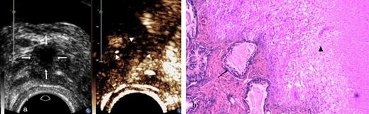 Prostate tuberculosis in a 23-year-old male. a, The axial TRUS examination demonstrated an irregular hypoechoic nodule (arrows) in the left side-of the peripheral zone. The axial CEUS examination demonstrated a heterogeneous hyperenhanced nodule (arrowheads) in the left side of the peripheral zone. b, Photomicrograph shows some prostatic acini (arrow) in the lower left side while some tuberculosis granuloma in the upper right side with typical caseous necrosis, epithelioid cells and langhans giant cells (arrow head) inside. (Hematoxylin& eosin, ×40). CEUS, contrast-enhanced ultrasound; TRUS, transrectal ultrasonography.