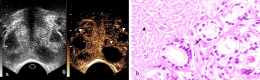 Prostate tuberculosis in a 17-year-old male. a, The axial TRUS examination demonstrated a change of the overall echogenicity and several poorly defined irregular hypoechoic nodules (arrows) inside. The axial CEUS examination demonstrated non-enhanced area (arrowheads) while heterogeneous enhancement in other parts of the prostate. b, Photomicrograph shows some prostatic acini (arrow) in the lower right side while caseous necrosis (arrow head) in the upper right side. (Hematoxylin & eosin, ×100). CEUS, contrast-enhanced ultrasound; TRUS, transrectal ultrasonography.